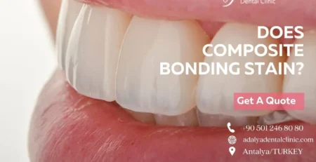 does composite bonding stain