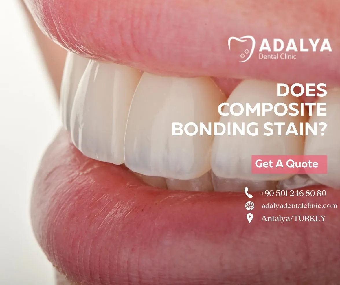 does composite bonding stain