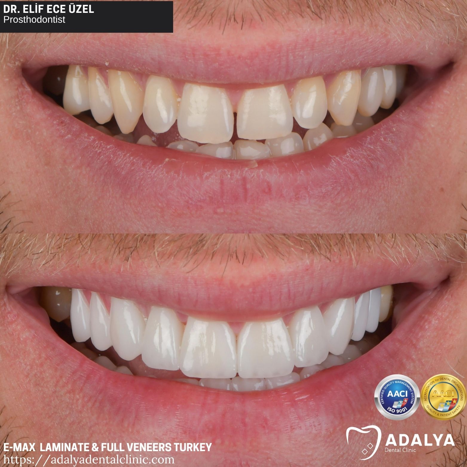 emax porcelain laminate veneer antalya turkey adalya