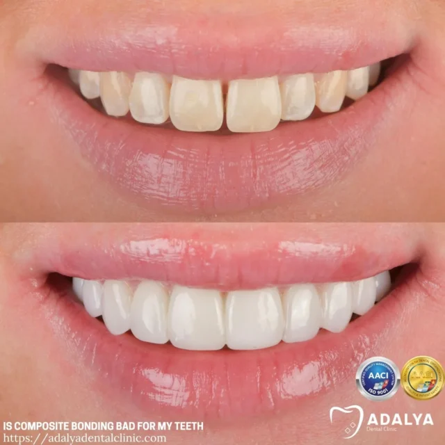 is dental bonding bad for my teeth