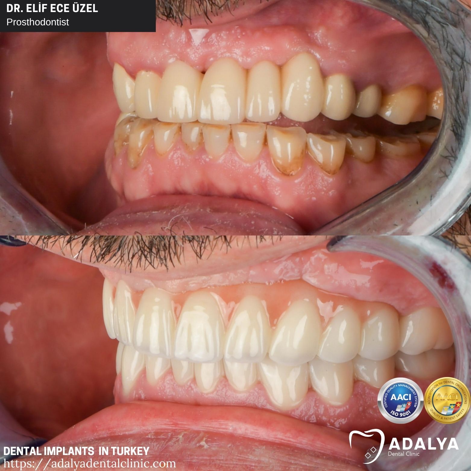 teeth implant antalya turkey adalya