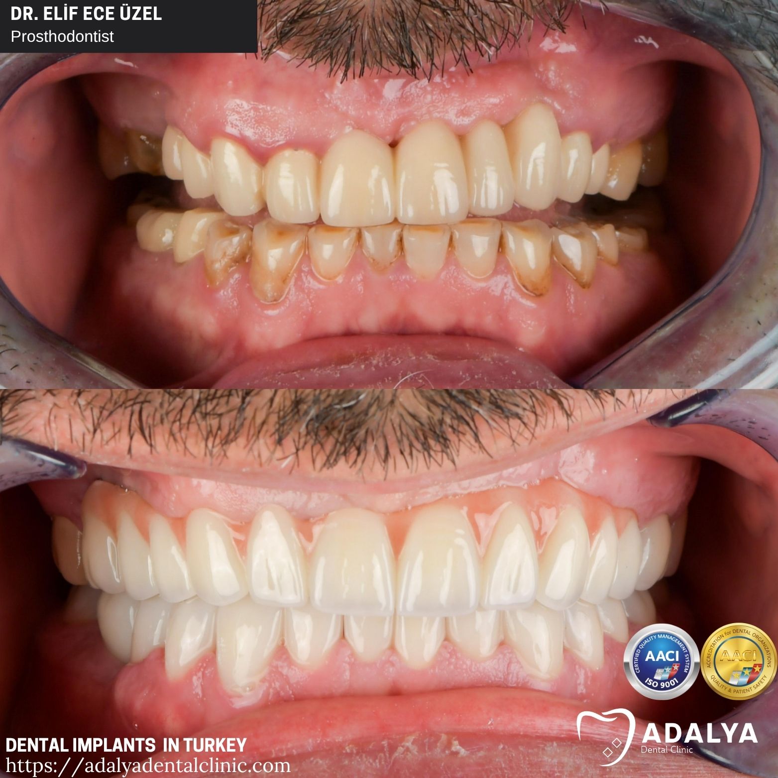 teeth implant turkey antalya adalya