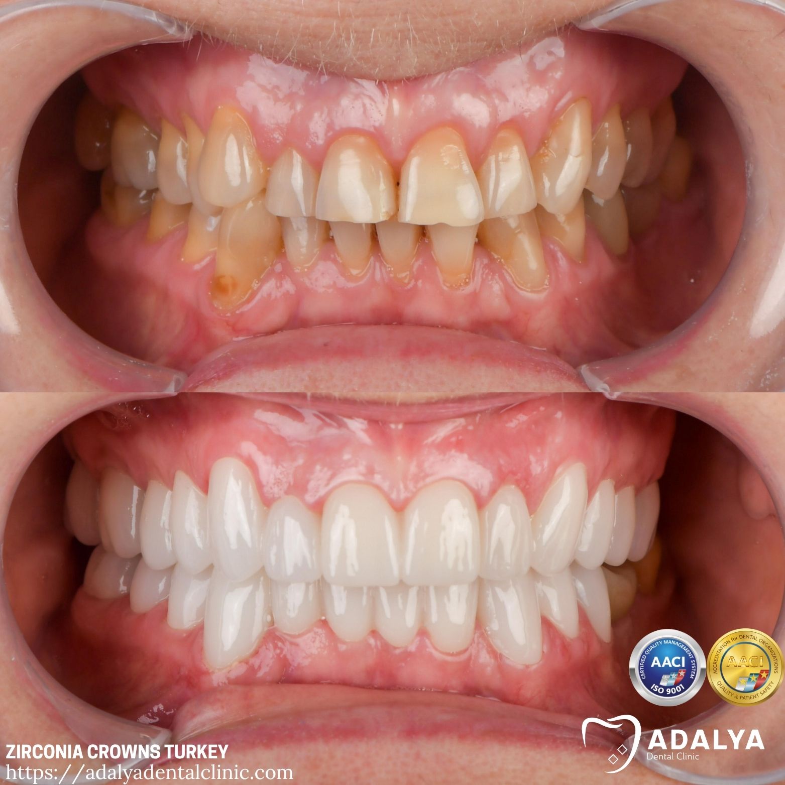 zirconium full veneers antalya turkey adalya