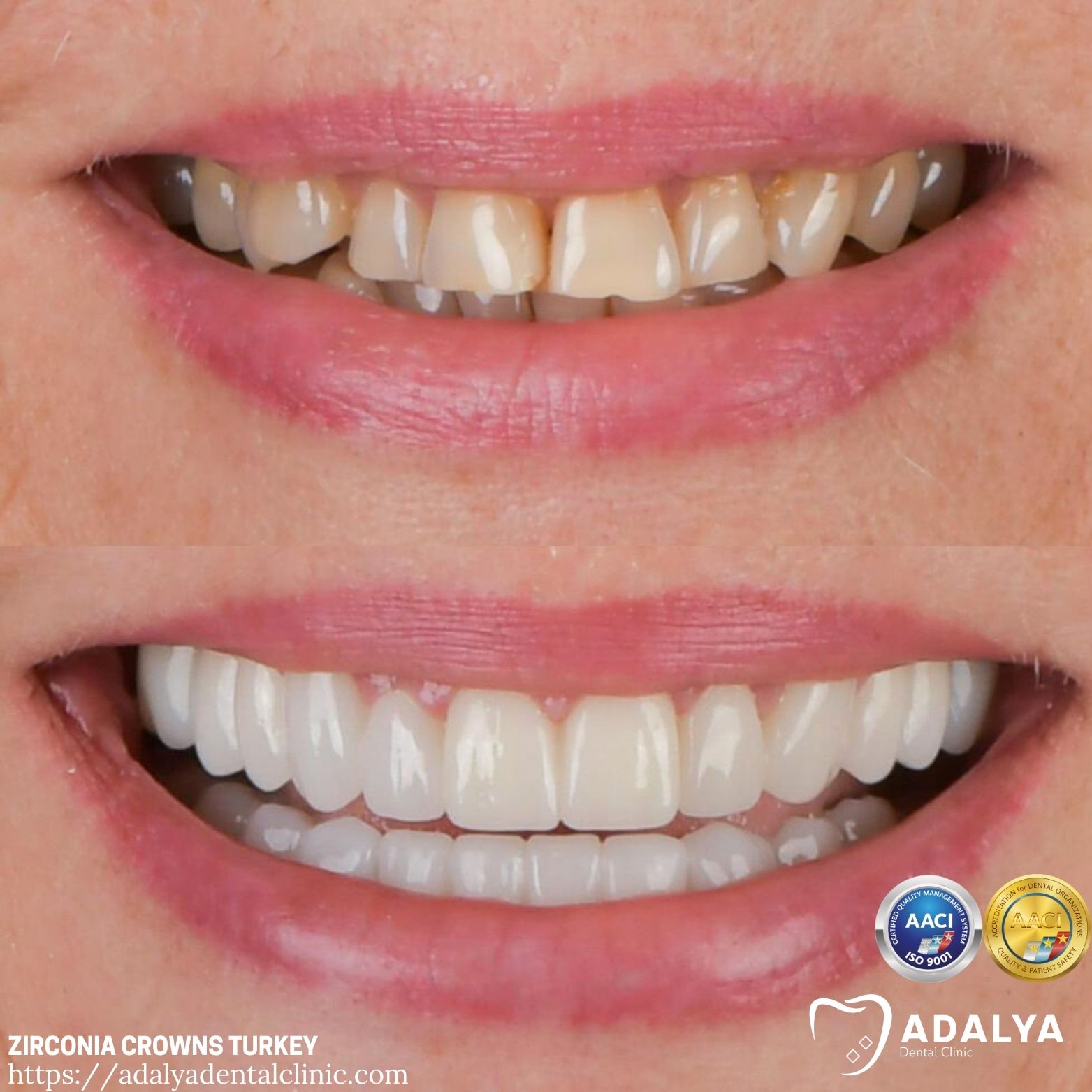 zirconium full veneers turkey antalya adalya