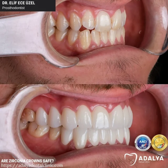 are zirconia crowns safe