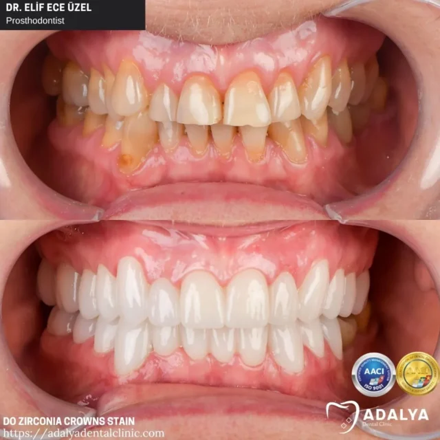 does zirconia crown stain