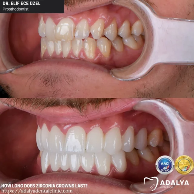how long does zirconia crown last