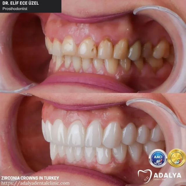 are zirconium crowns stronger than natural tooth